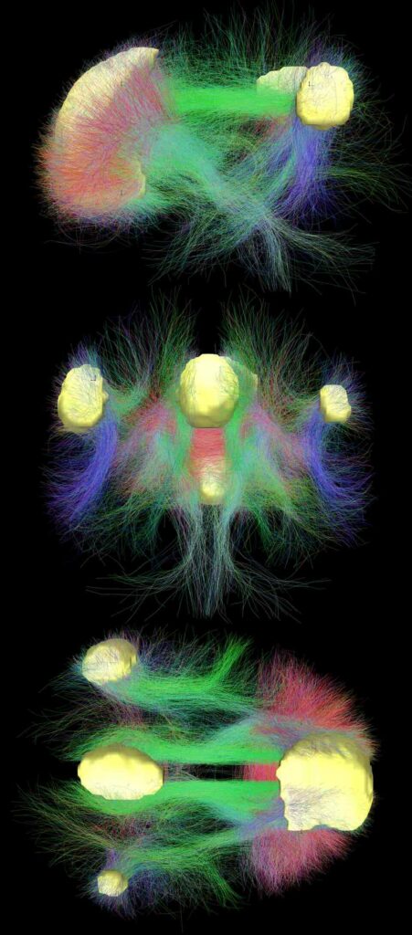 Mappa della connettività della rete di default (in giallo) nel cervello (Immagine Andreashorn, CC BY-SA 4.0).